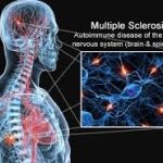 Multiple sclerosis cure