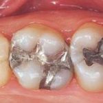 amalgams and health