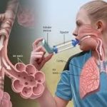 asthma