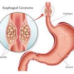 cancer of oesophagus