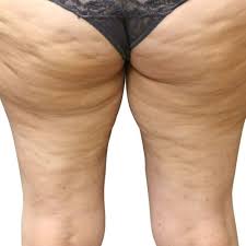 natural treatment for cellulite