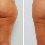 cellulite treatment