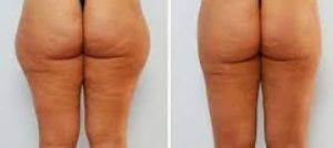 cellulite treatment