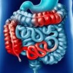 crohn's disease
