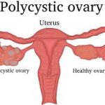 polycystic ovary