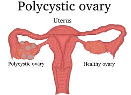 polycystic ovary