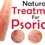 Psoriasis - before