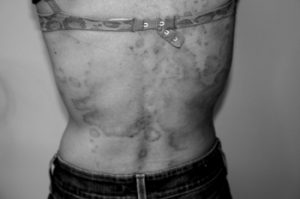 psoriasis - after