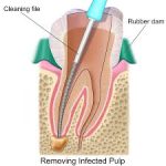 root canals