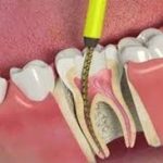 root canals and health
