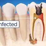 root canals and illness