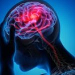 stroke cure
