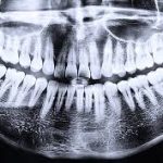 tooth foci