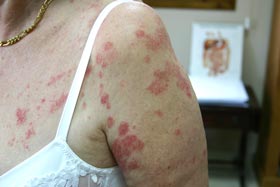 Case 2: chronic psoriasis before treatment