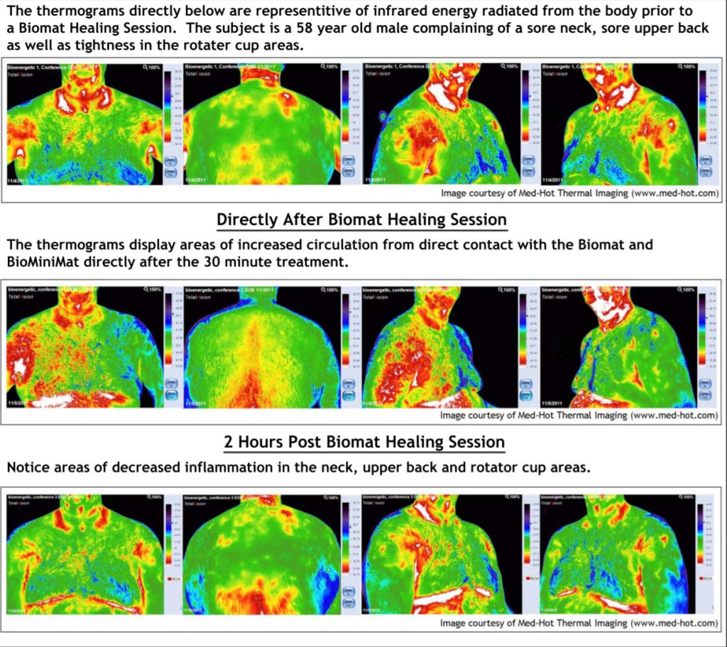 Thermograms before, directly after and two hours after a BioMat session