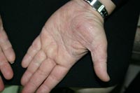 Case 1: the same hands two months into the Da Vinci Candida Treatment