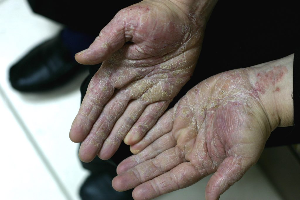 Case 1: hands split and cracked after IV antibiotics, before treatment
