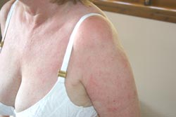 Case 2: three months after completing the Da Vinci Candida Treatment