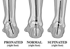 Pronated, normal and supinated right foot
